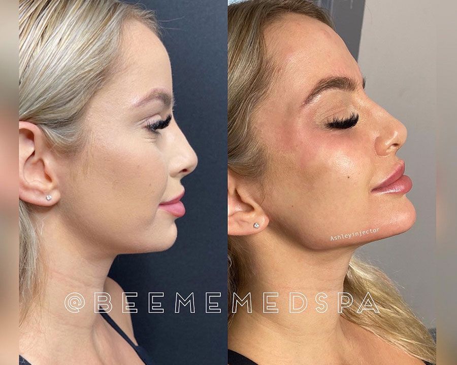 beeme-med-spa_houston-medical-spa_chin-filler-02