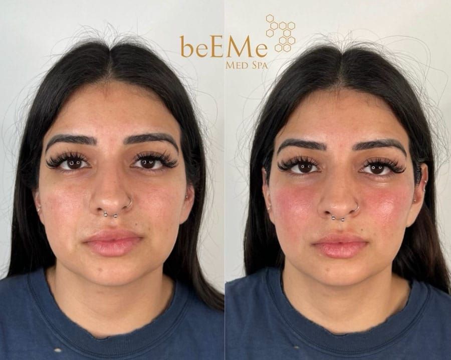 beeme-med-spa_houston-medical-spa_facial-rejuvenation-02