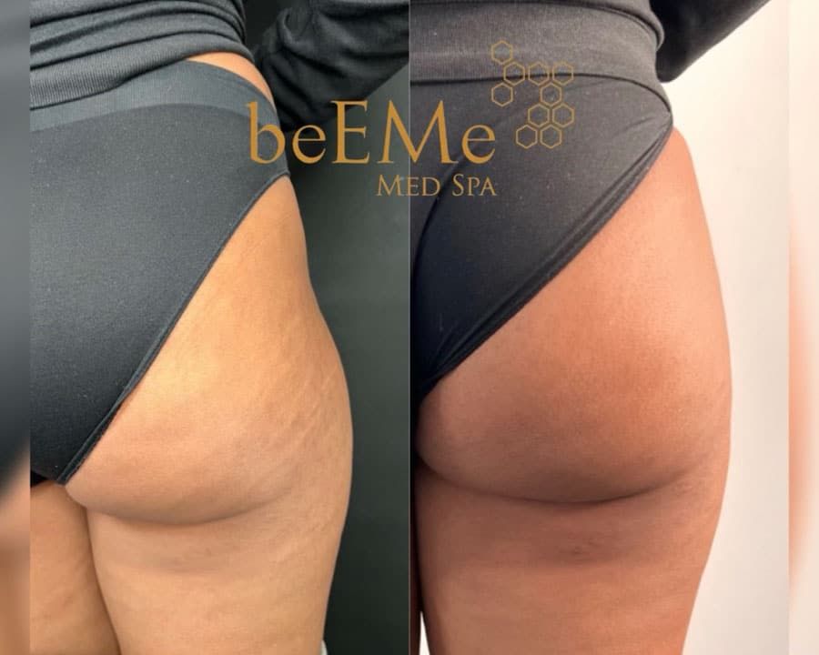 beeme-med-spa_houston-medical-spa_brazilian-butt-lift-01