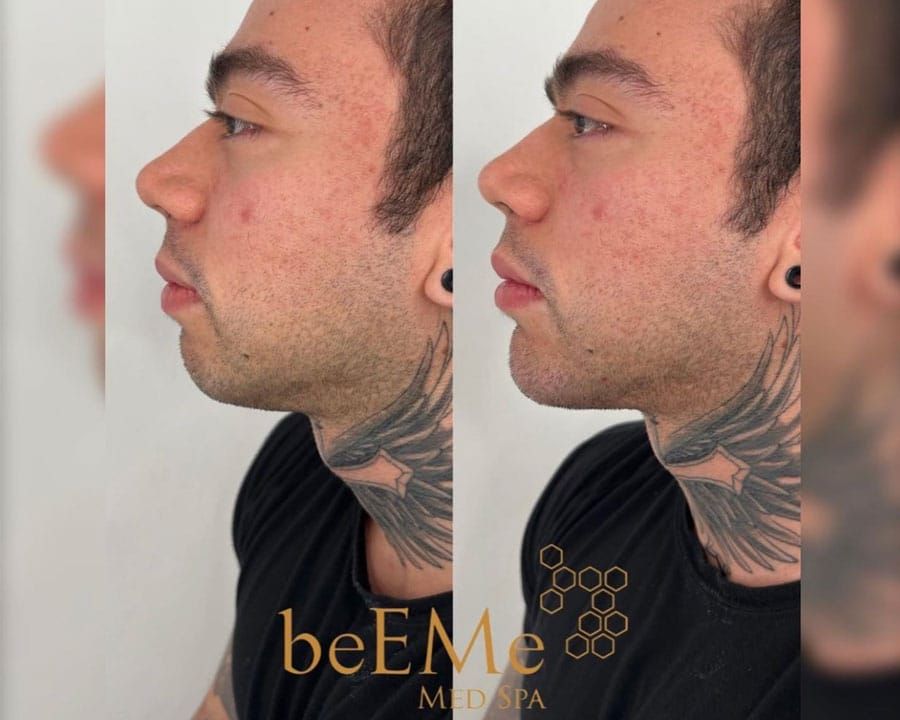 beeme-med-spa_houston-medical-spa_chin-filler-01