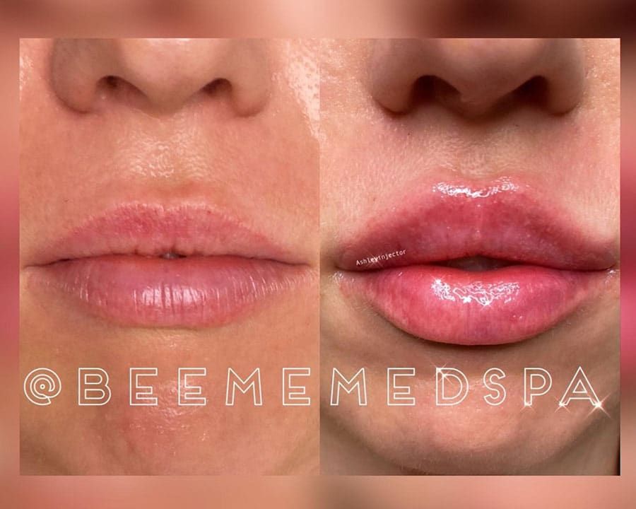 beeme-med-spa_houston-medical-spa_Russian-Lip-Filler-3