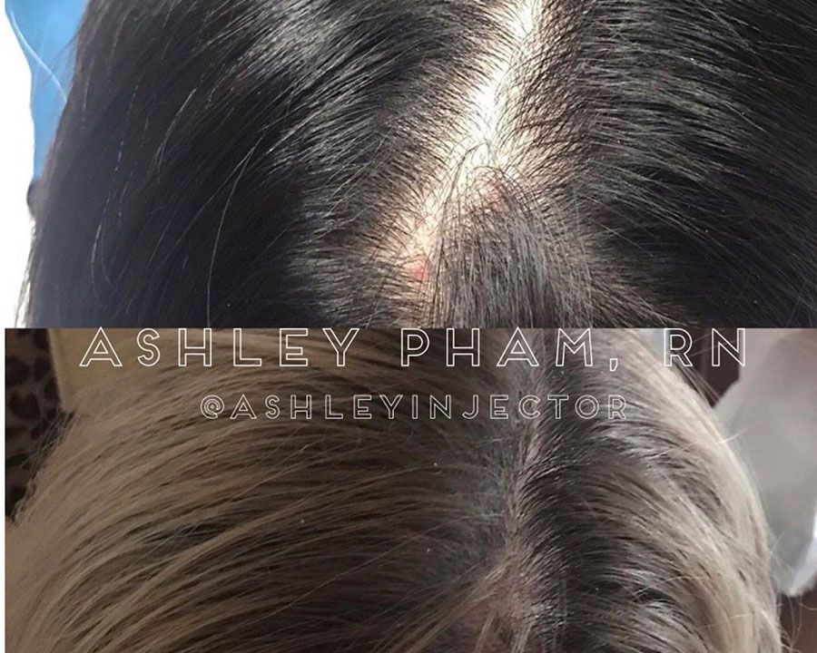 beeme-med-spa_houston-medical-spa_hair-restoration-01